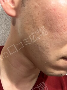 治療直後の症例写真