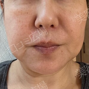 治療直後の症例写真