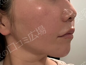 治療直後の症例写真