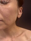 施術前の状態