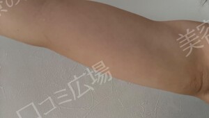治療直後の症例写真