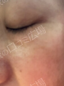治療直後の症例写真
