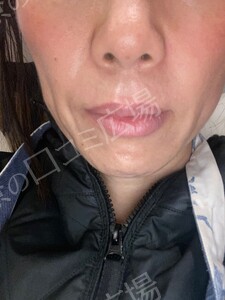 治療直後の症例写真