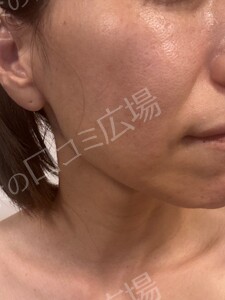 【初回｜平日限定】高出力！ルメッカ2周｜透明感あるお肌に🌿の治療前の症例写真