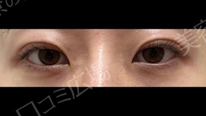 治療直後の症例写真