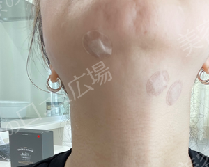 治療直後の症例写真