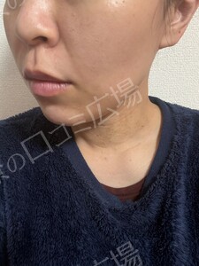 治療結果の症例写真