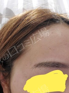 治療直後の症例写真