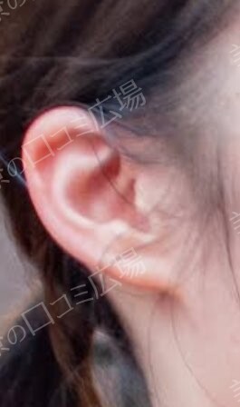 【女性専門美容外来】サンライズ美容外科のピアス穴あけの症例写真[ビフォー]