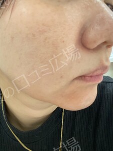 治療前の症例写真