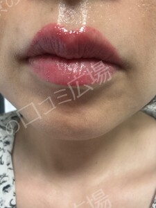 リップ ＆ アイライン上下 アートメイク 2回 モニター施術の治療直後の症例写真
