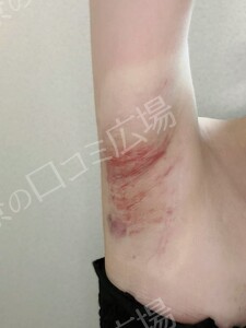 治療直後の症例写真