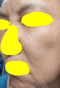治療直後の症例写真