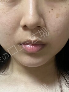治療直後の症例写真