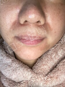 治療結果の症例写真