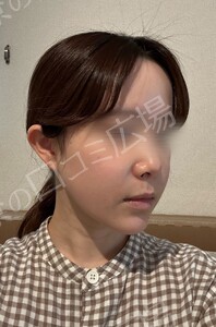 貴族手術（鼻翼基部プロテーゼ）｜ほうれい線を改善の治療直後の症例写真