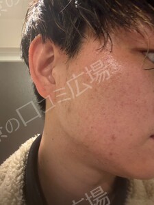 治療直後の症例写真