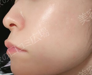 治療直後の症例写真