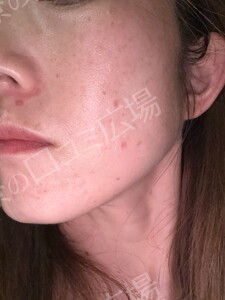 治療結果の症例写真