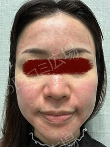 治療直後の症例写真