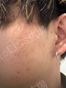 治療前の症例写真