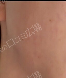 治療直後の症例写真