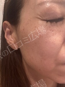 【初回｜平日限定】高出力！ルメッカ2周｜透明感あるお肌に🌿の治療直後の症例写真