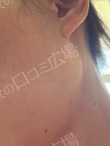 治療直後の症例写真