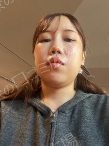 ボトックス韓国製200単位｜エラ・肩・ワキ・ふくらはぎからの治療直後の症例写真