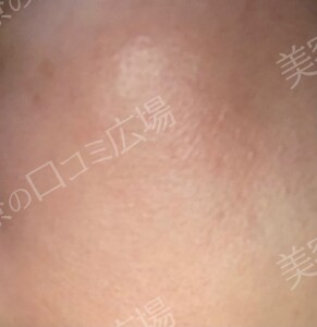 治療直後の症例写真