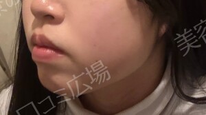 治療直後の症例写真