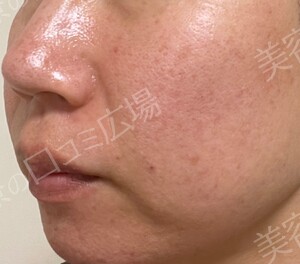 治療直後の症例写真