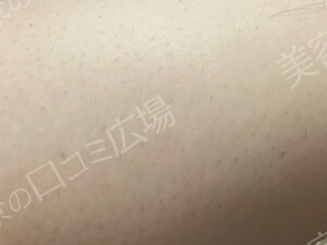 口コミ広場会員様限定！全身脱毛5回コース 146,300円の治療結果の症例写真