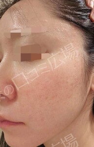 治療直後の症例写真