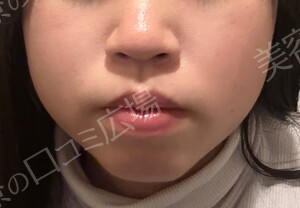 治療直後の症例写真