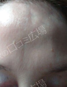 治療直後の症例写真