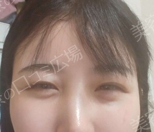 【おすすめ！】　涙袋ヒアルロン酸（0.1㏄）の治療直後の症例写真