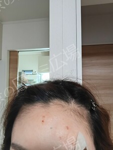 治療直後の症例写真
