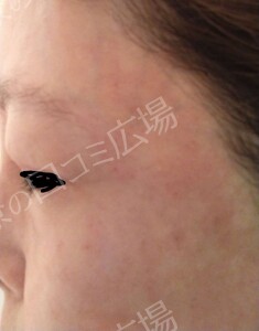 治療直後の症例写真