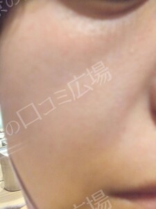 治療直後の症例写真