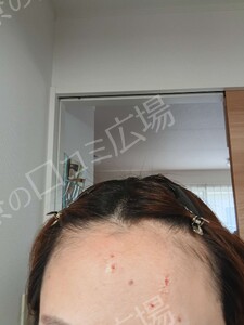 治療直後の症例写真