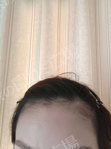 治療結果の症例写真