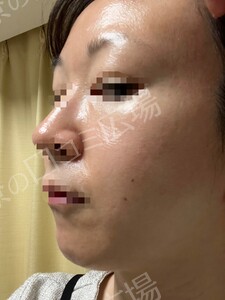 治療直後の症例写真