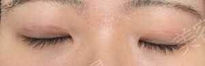 植村美容外科_埋没法（埋没法(5年保証)3点とめ）の治療結果の症例写真