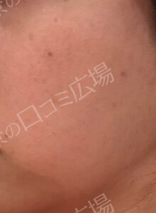 顔脱毛1回｜新宿院：ジェントルマックスプロプラスの治療前の症例写真