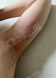 治療直後の症例写真