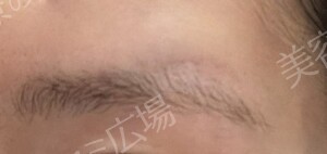 【口コミ広場期間限定価格】韓国製ボトックス｜1部位の治療前の症例写真