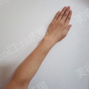 白玉ハイパー点滴（高濃度グルタチオン1200㎎）の治療直後の症例写真