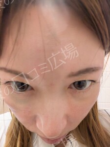 治療直後の症例写真