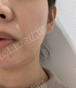 医療ハイフ｜頬・フェイスラインのたるみの治療直後の症例写真